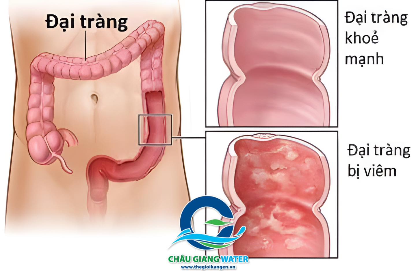 Công dụng nước ion kiềm đối với bệnh viêm đại tràng?