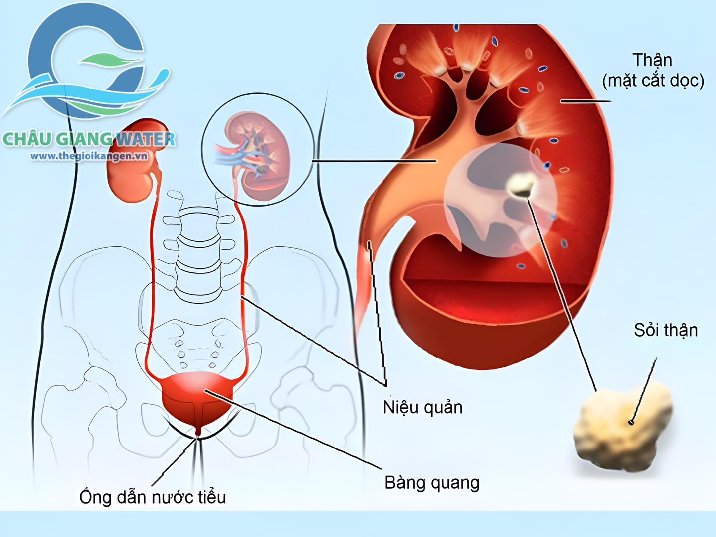 Nước ion kiềm giàu hydro  và bệnh sỏi thận ?